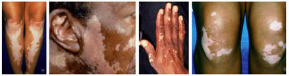 vitiligo support meeting